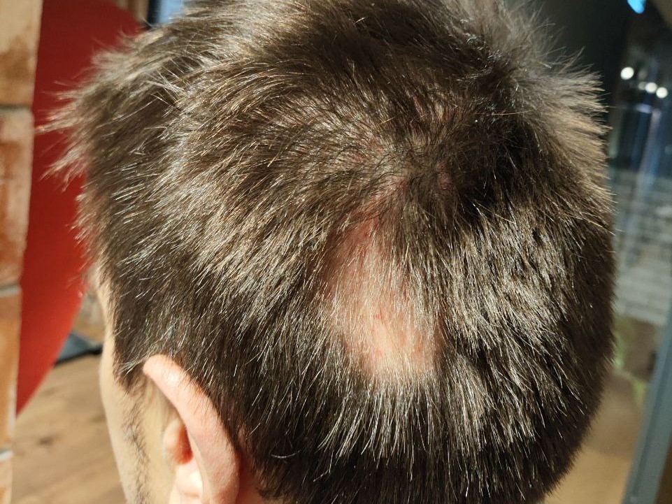 очаговая, гнезная алопеция, ареата