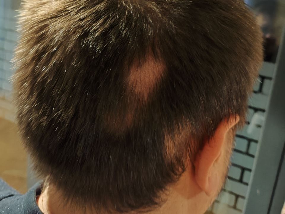 очаговая, гнезная алопеция, ареата