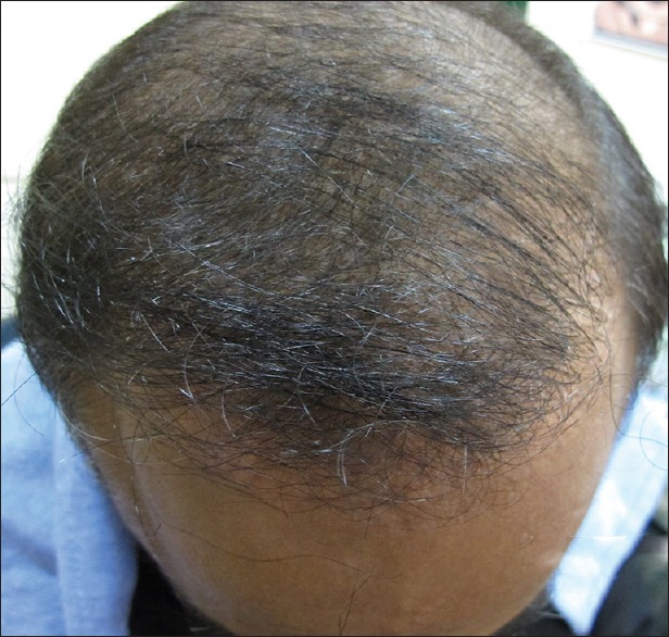 дермароллер при выпадении волос