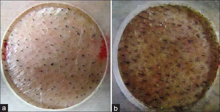 микронидлинг при андрогенетической алопеции