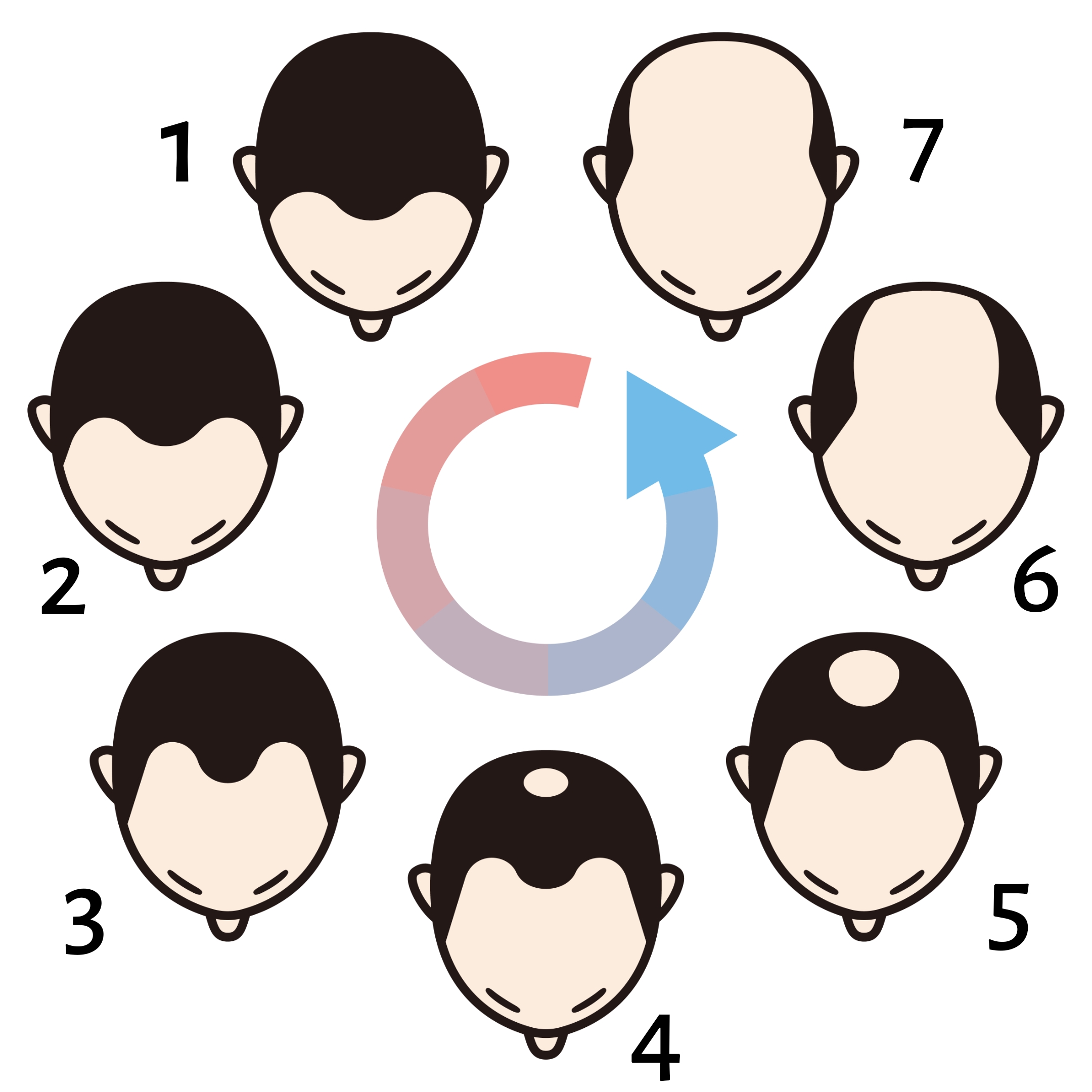 Модель мужской АГА по Гамильтону