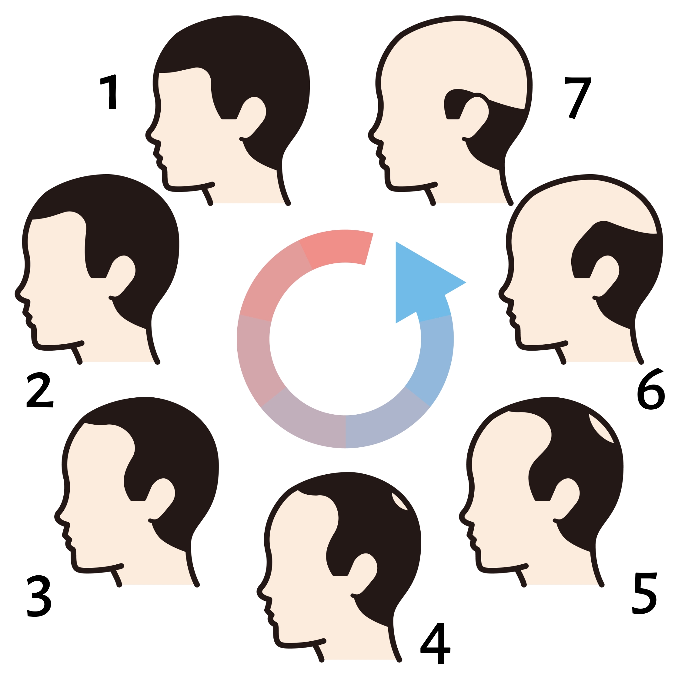 Облысение по мужскому типу