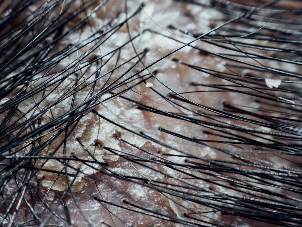 Сухая себорея, себорейный дерматит