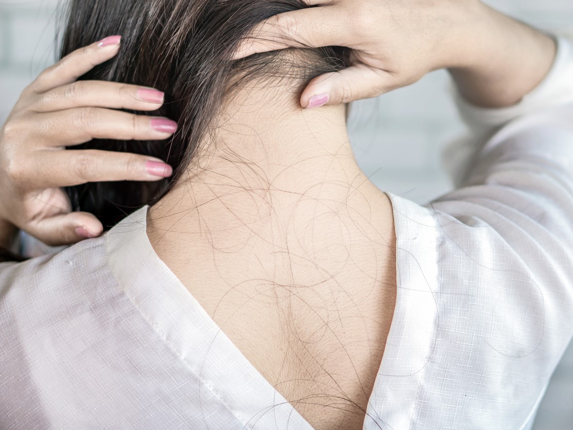 выпадение волос после ковид, короны