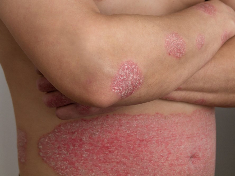 Псориаз по телу