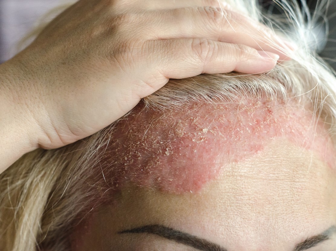 псориаз головы