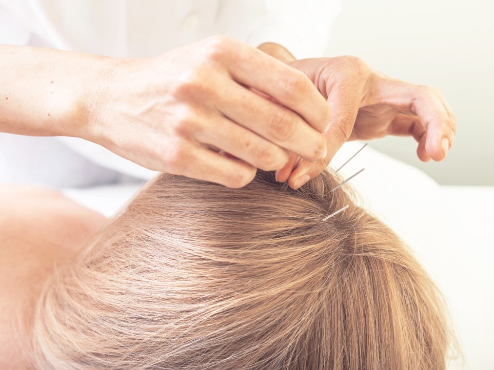 аккупунктура против выпадения волос