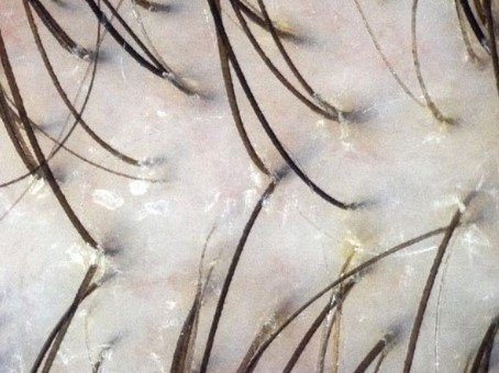 результаты фототрихограммы