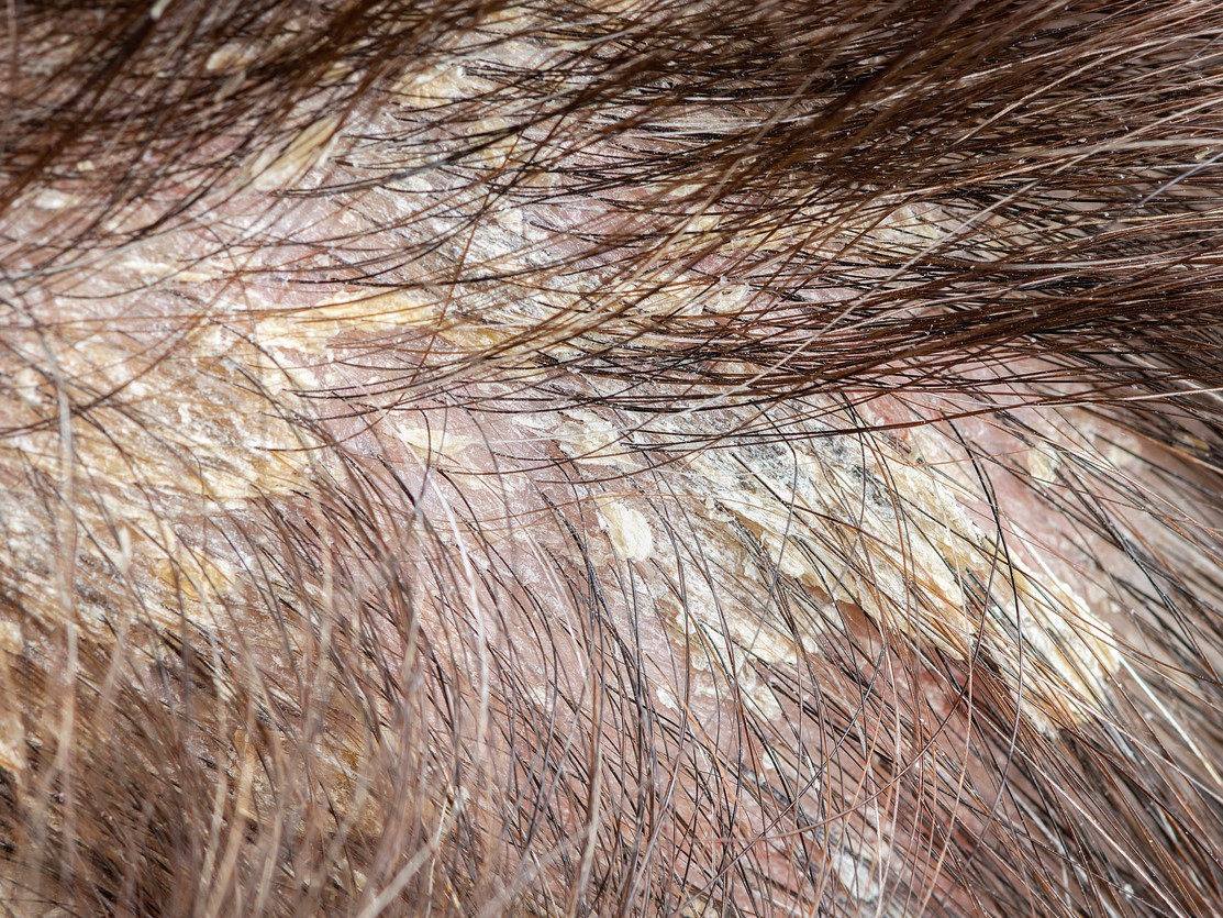 Жирная себорея, себорейный дерматит