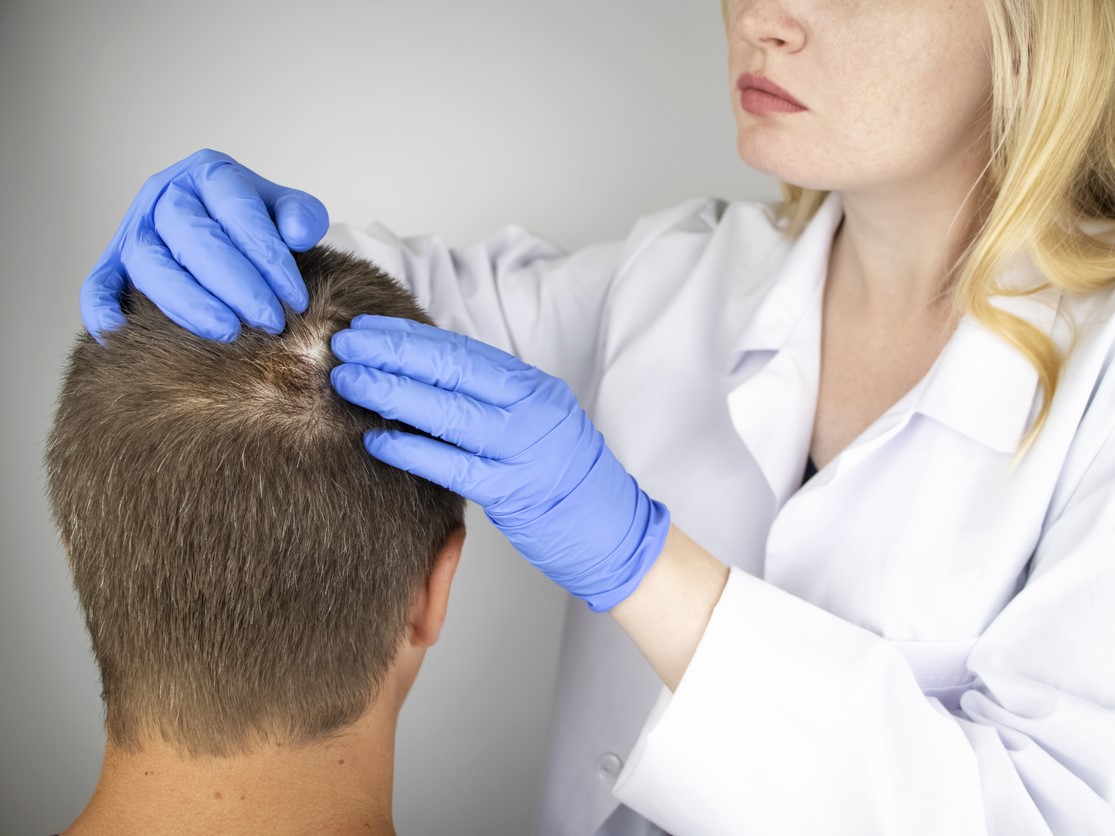 очаговая, гнезная алопеция, ареата