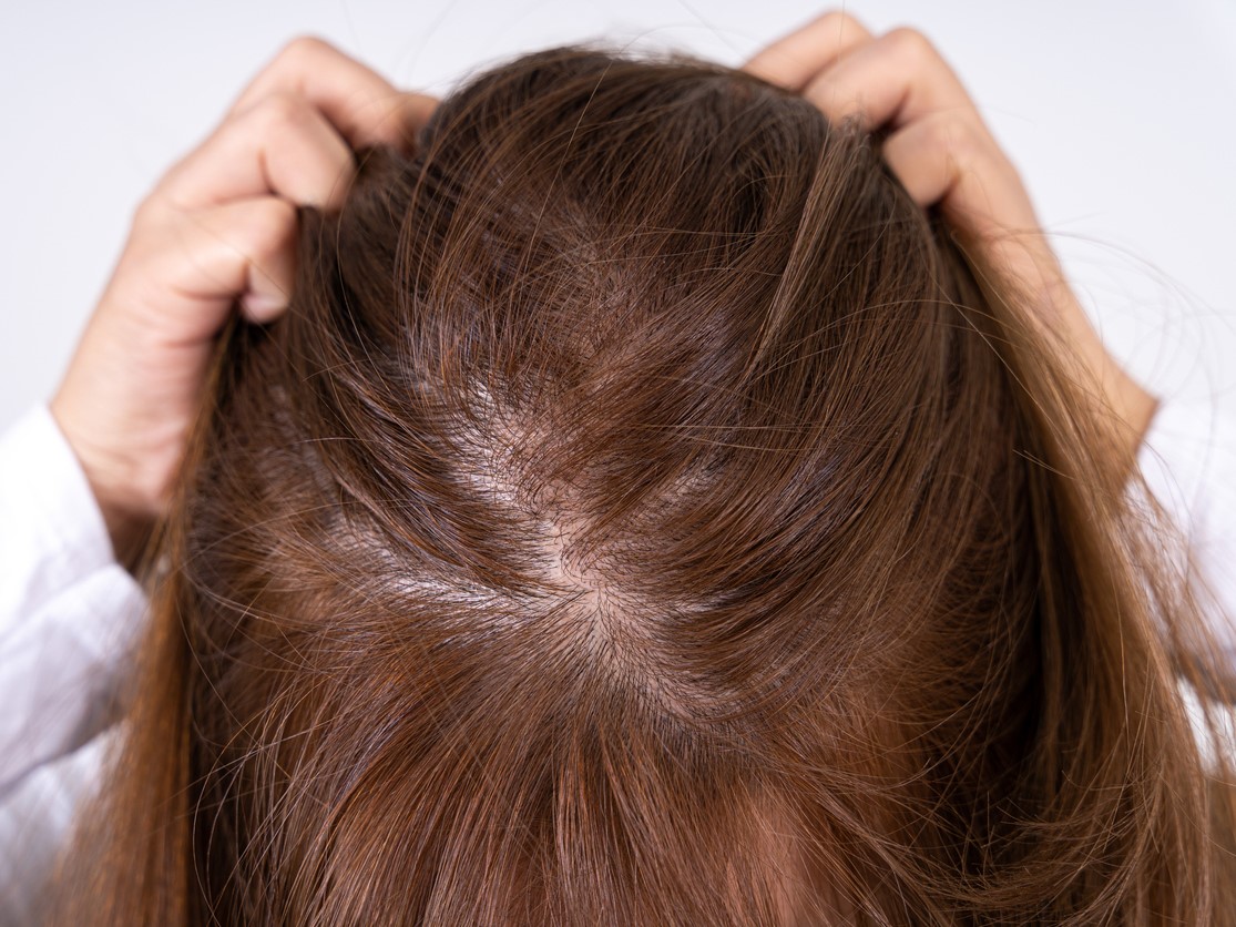 диффузное поредение волос