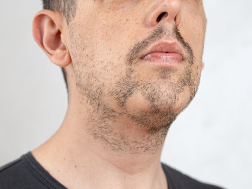 очаговая алопеция