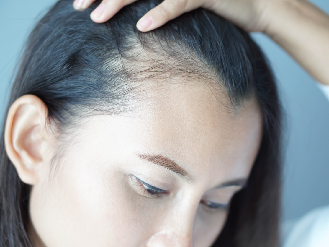 Модель женской АГА по Гамильтону