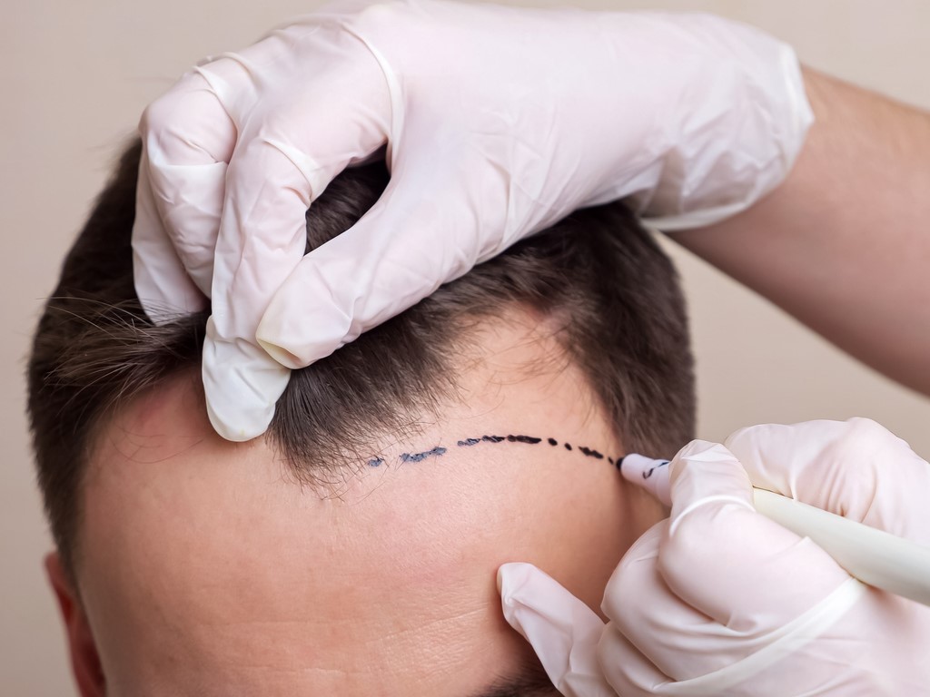 пересадка волос