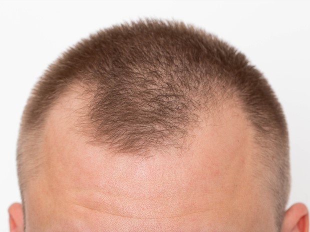 АГА у мужчин