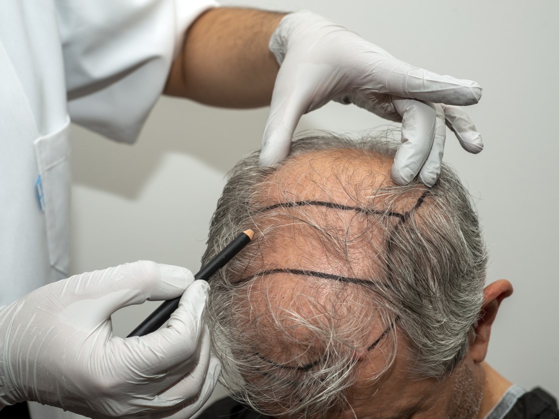 пересадка волос