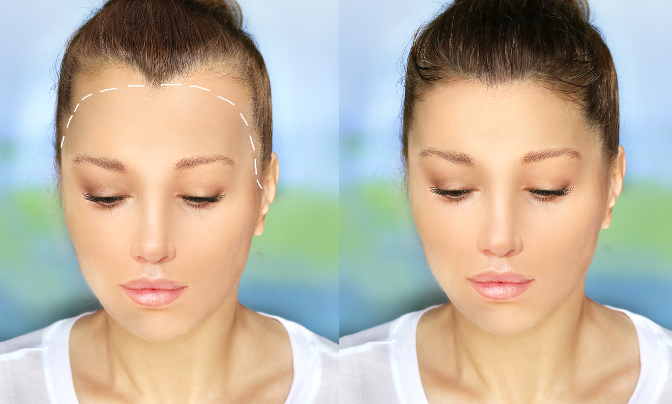 Модель женской АГА по Гамильтону