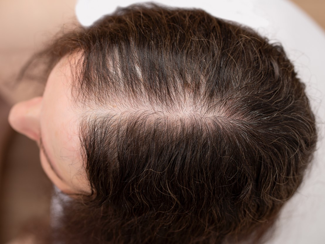 Модель АГА у женщин по Людвигу