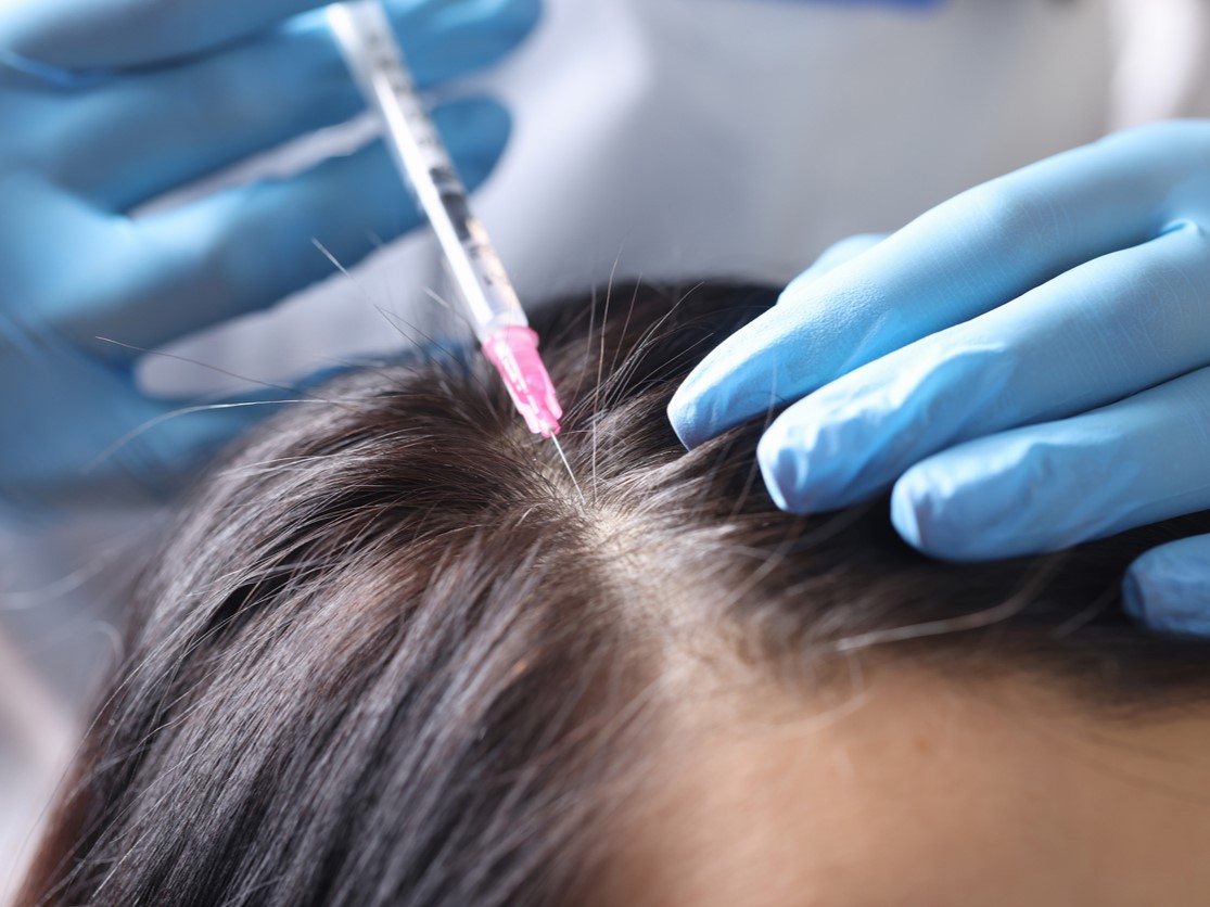 карбокситерапия при выпадении волос 