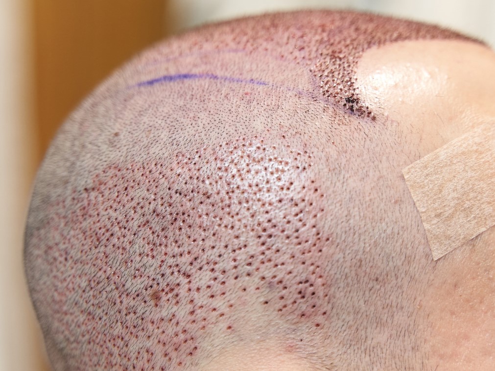 пересадка волос