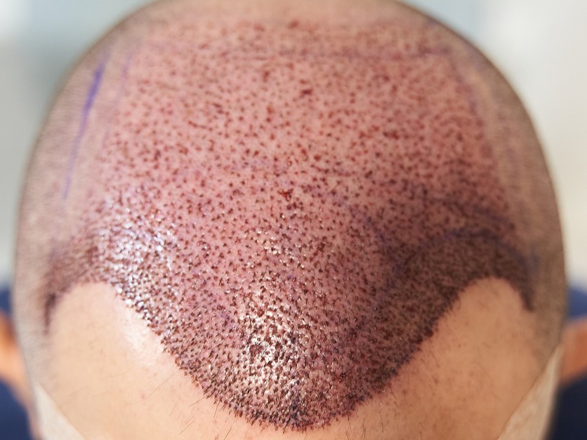 трансплантация волос