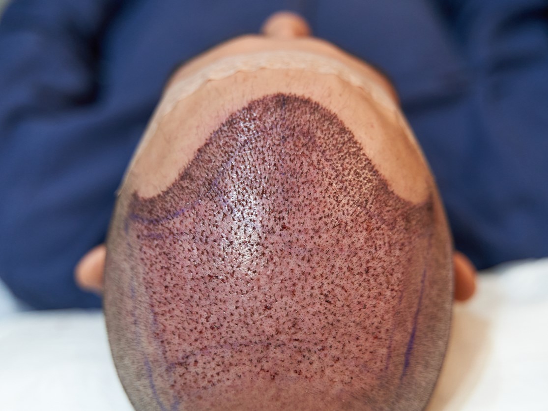 пересадка волос