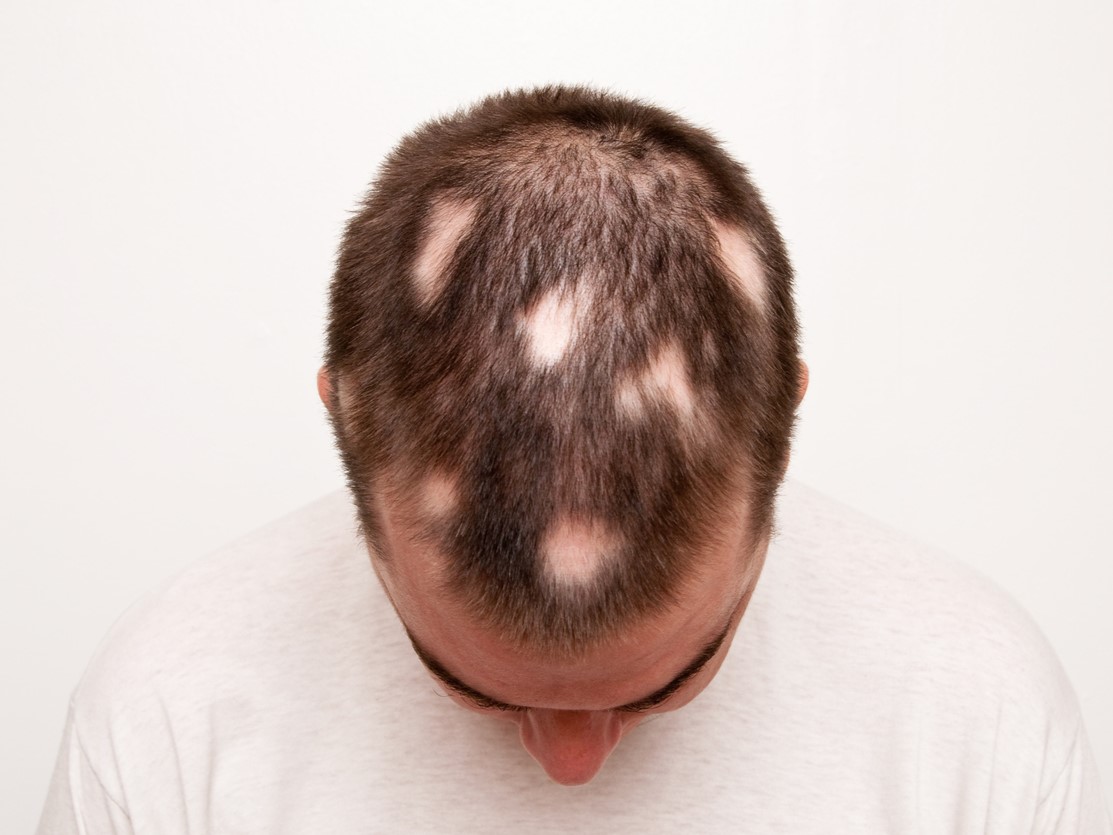 очаговая алопеция, гнездная алопеция, ареата