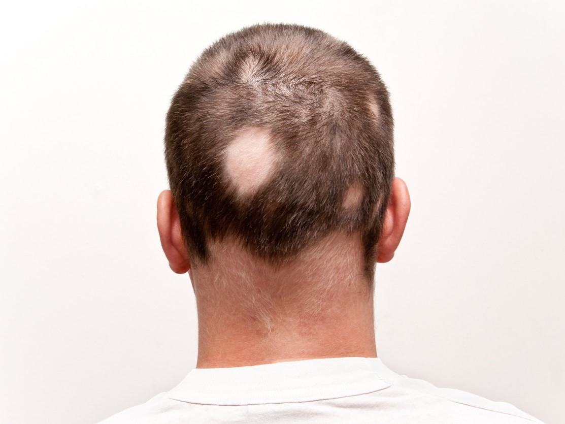 Тотальная алопеция из-за очаговой