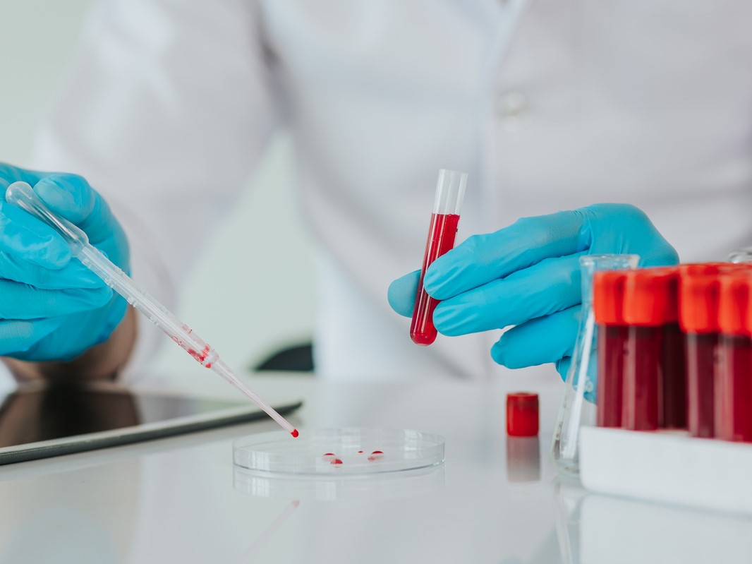 гематолог, анемия и выпадение волос, анализы