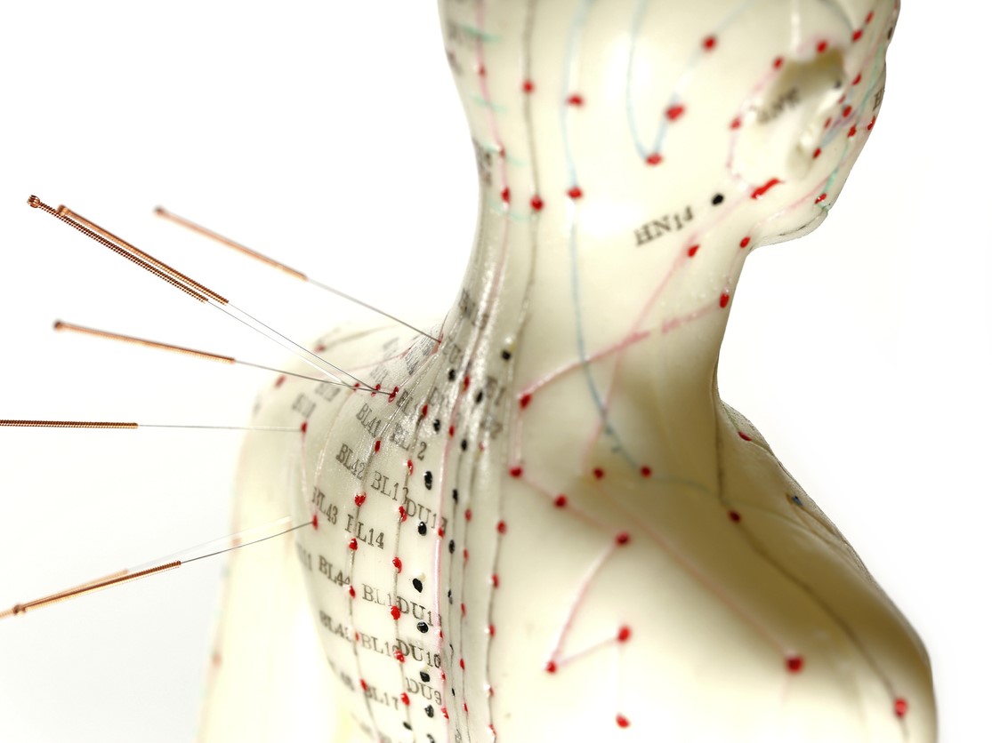 иглоукалывание от выпадения волос