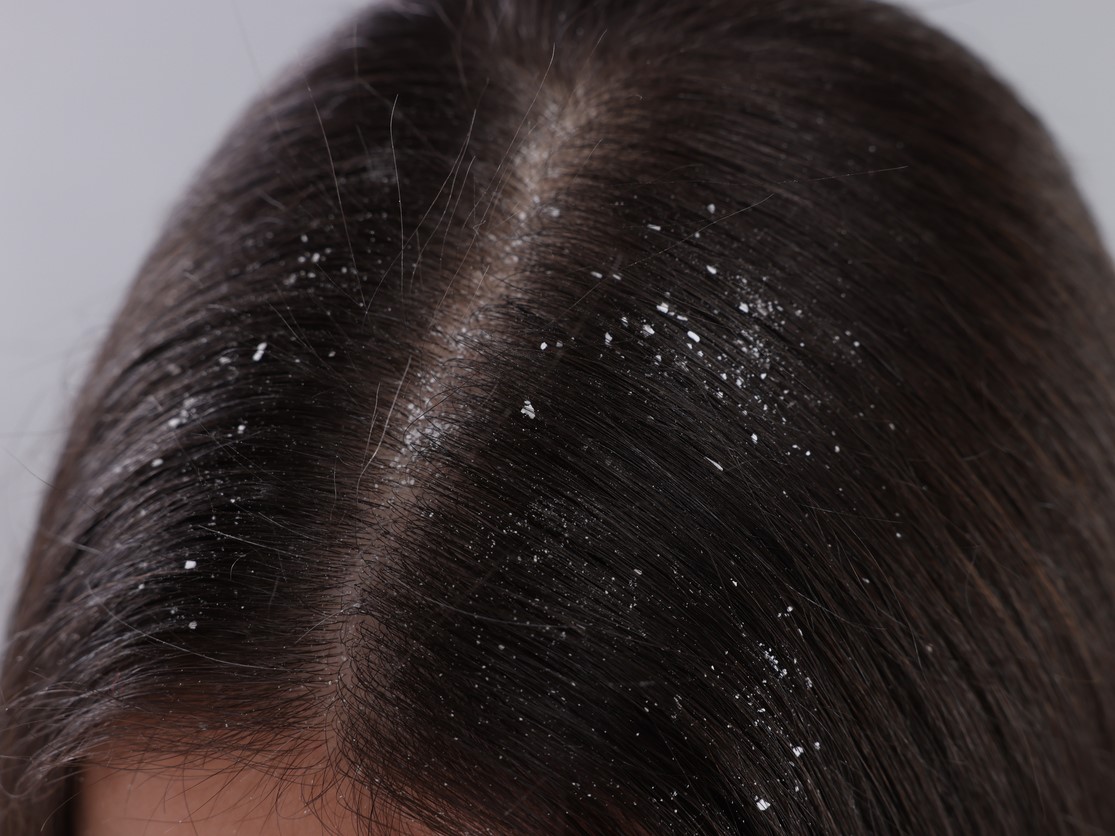 Перхоть, сухая перхоть