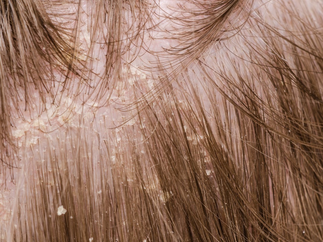 Жирная перхоть