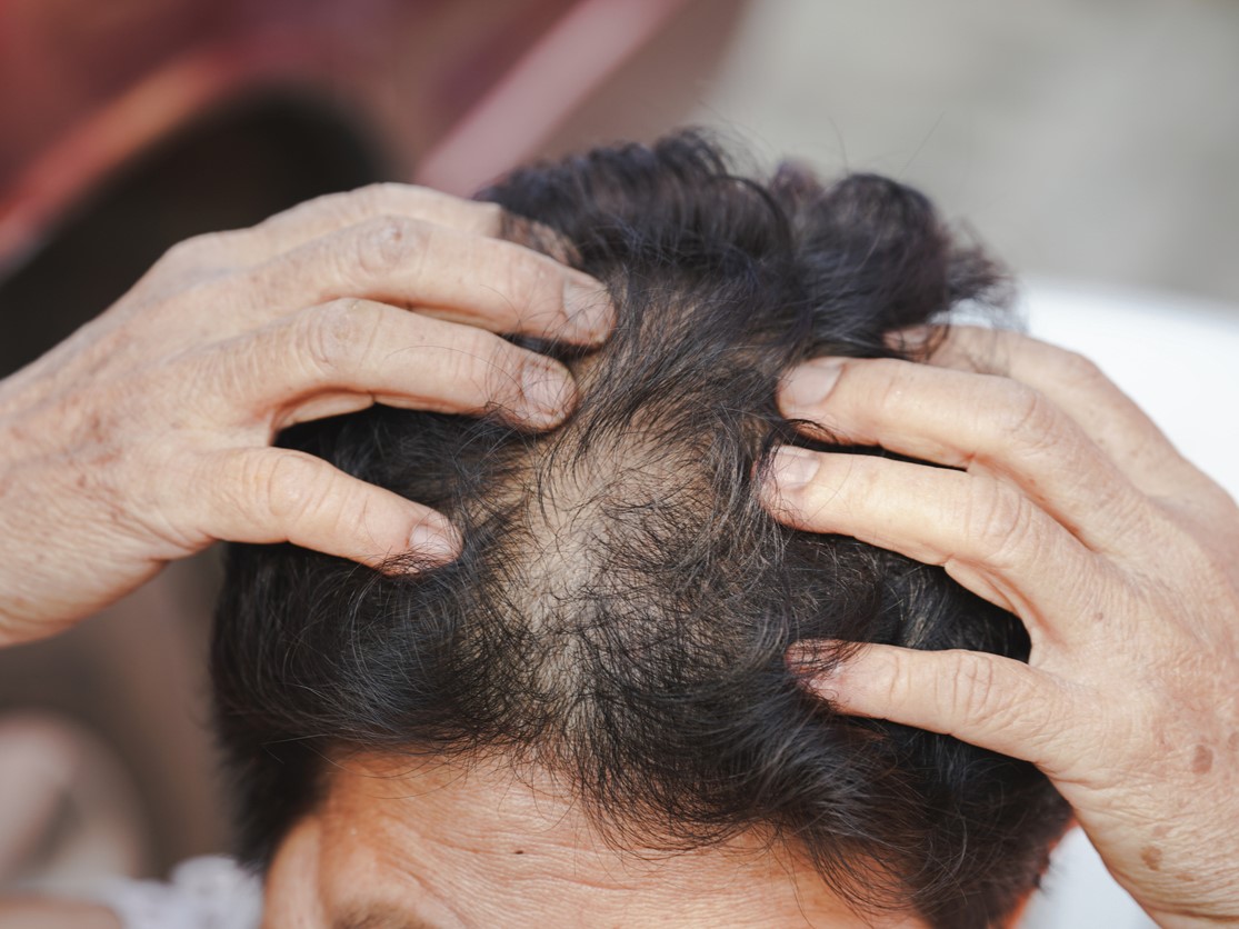 Алопеция при менопаузе