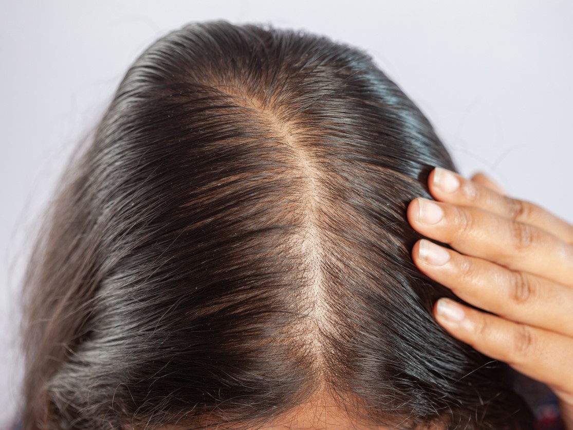 диффузное выпадение, поредение волос