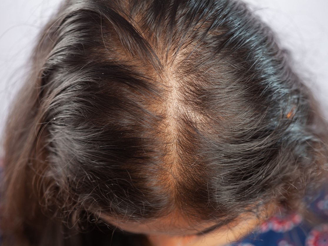 АГА у женщин