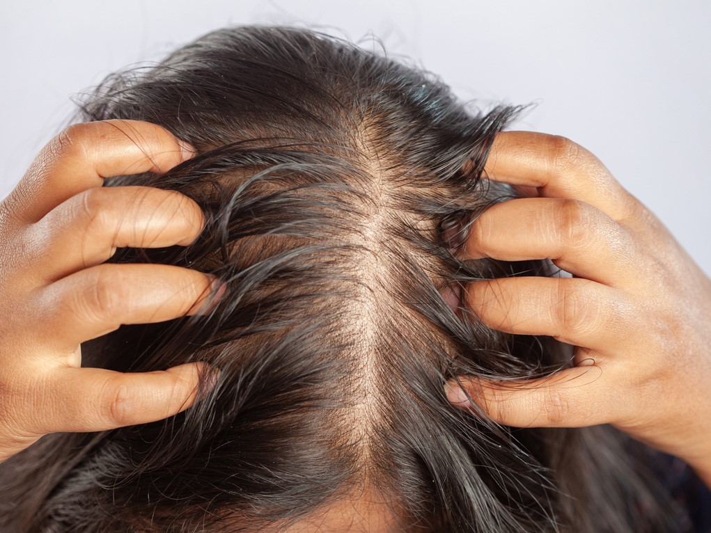 выпадение волос по всей голове, диффузная алопеция