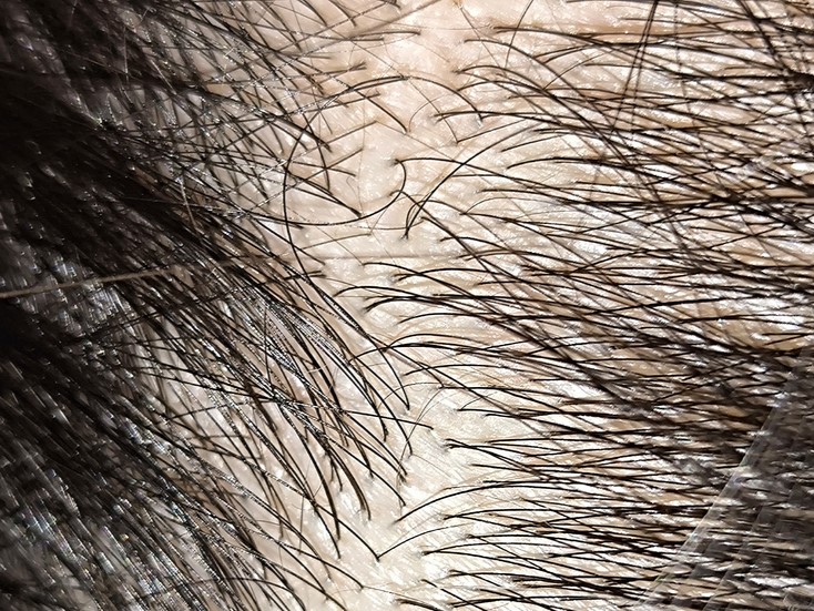 диагностика волос, трихоскопия