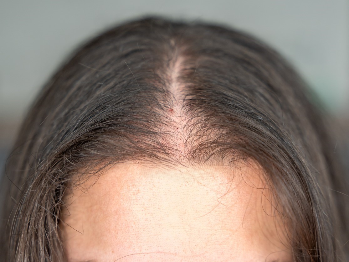 алопеция у женщин