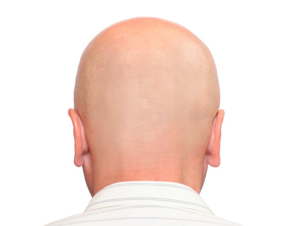 полное облысение