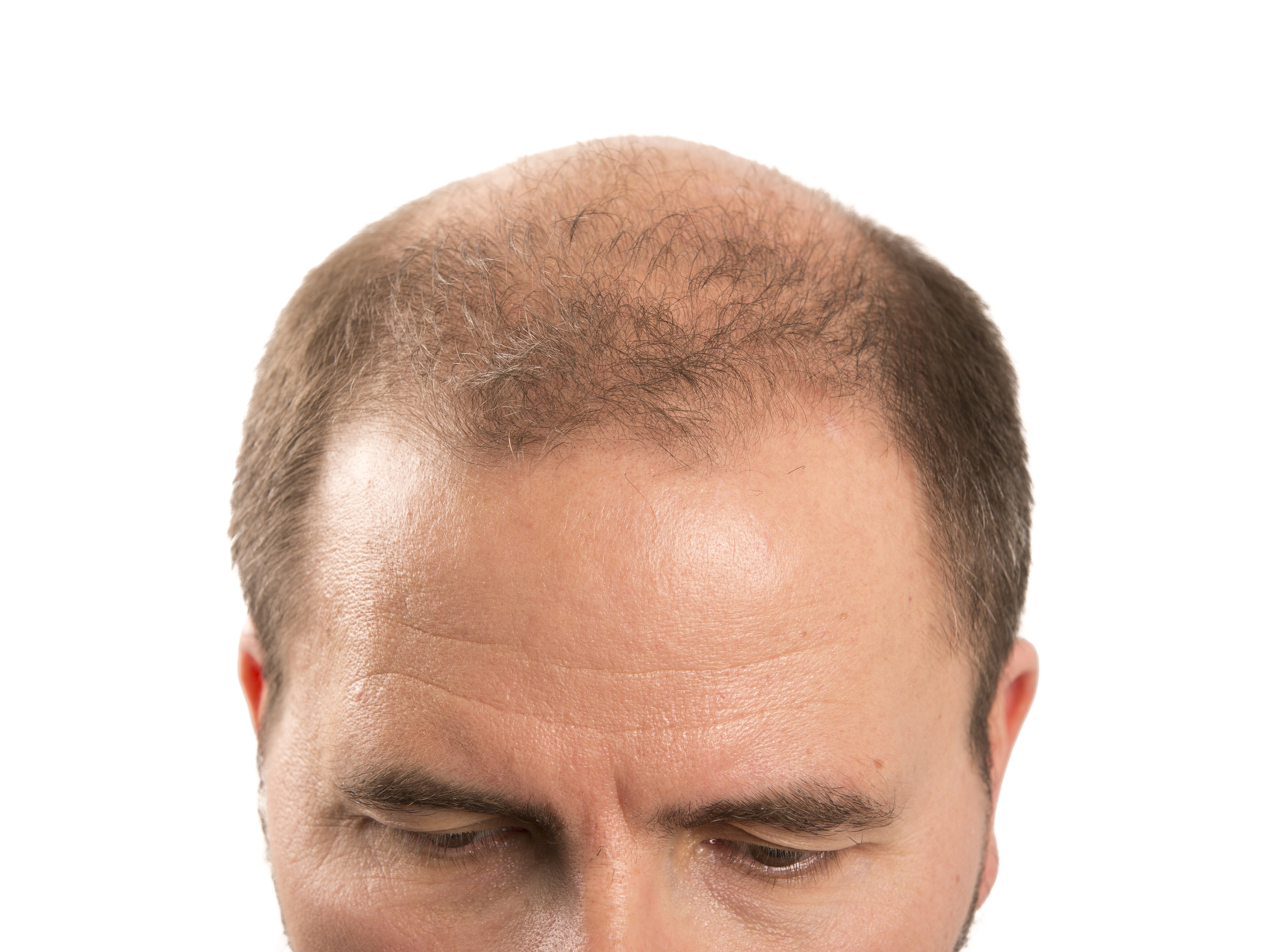 АГА у мужчин