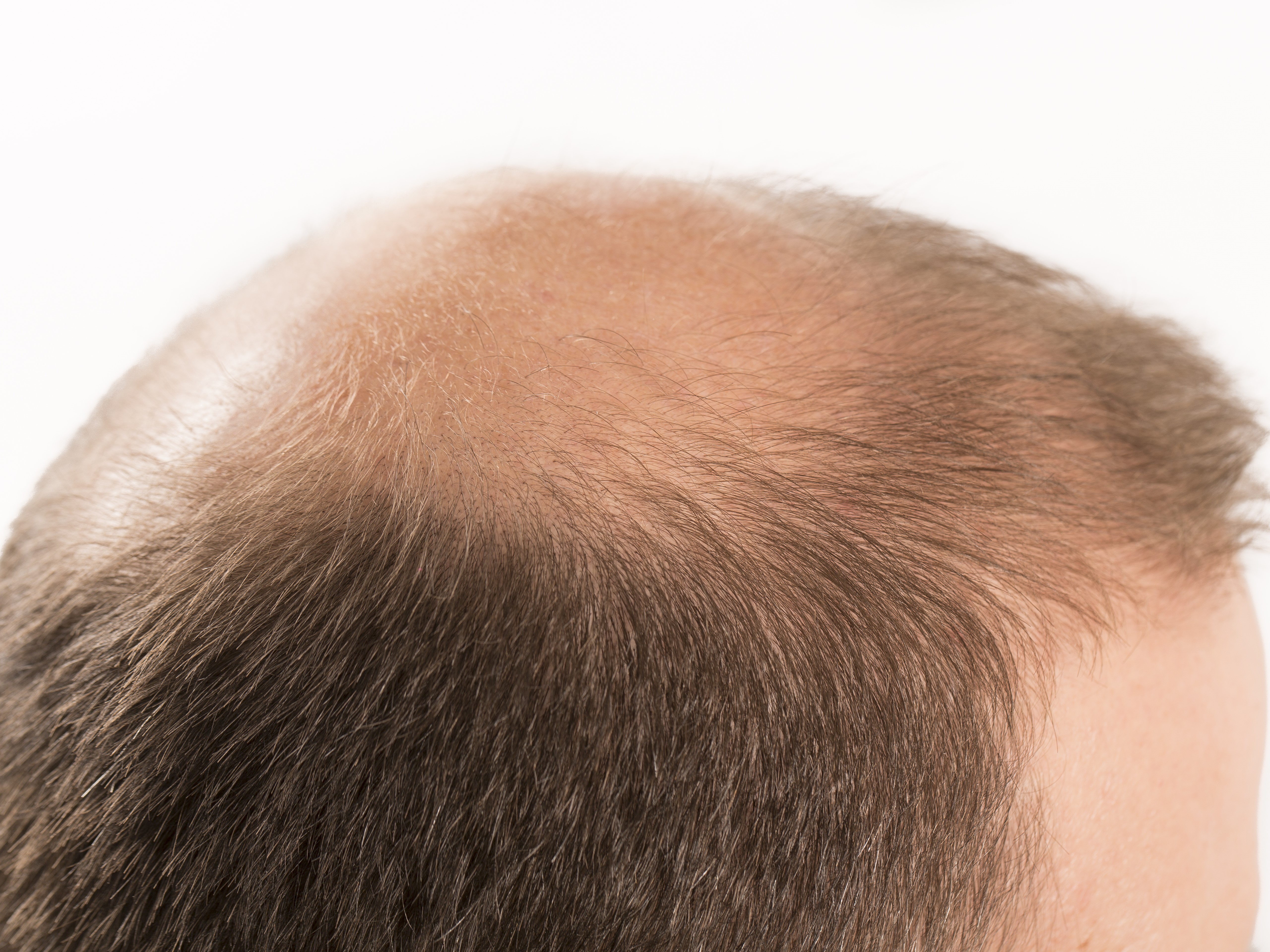 АГА у мужчин