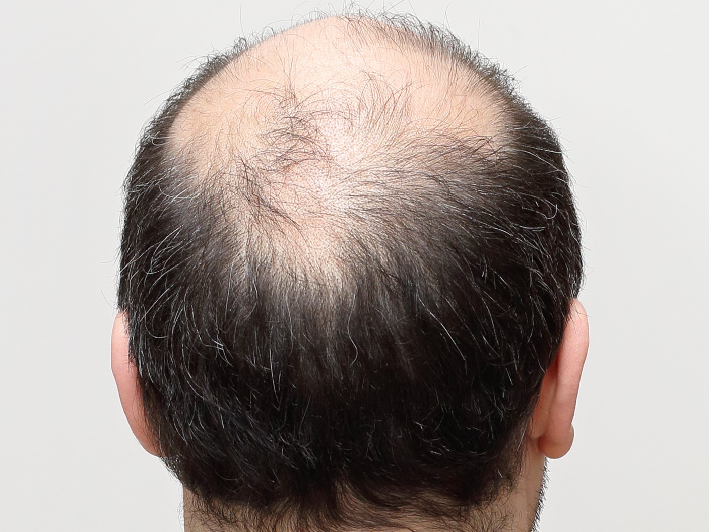 Алопеция у мужчин