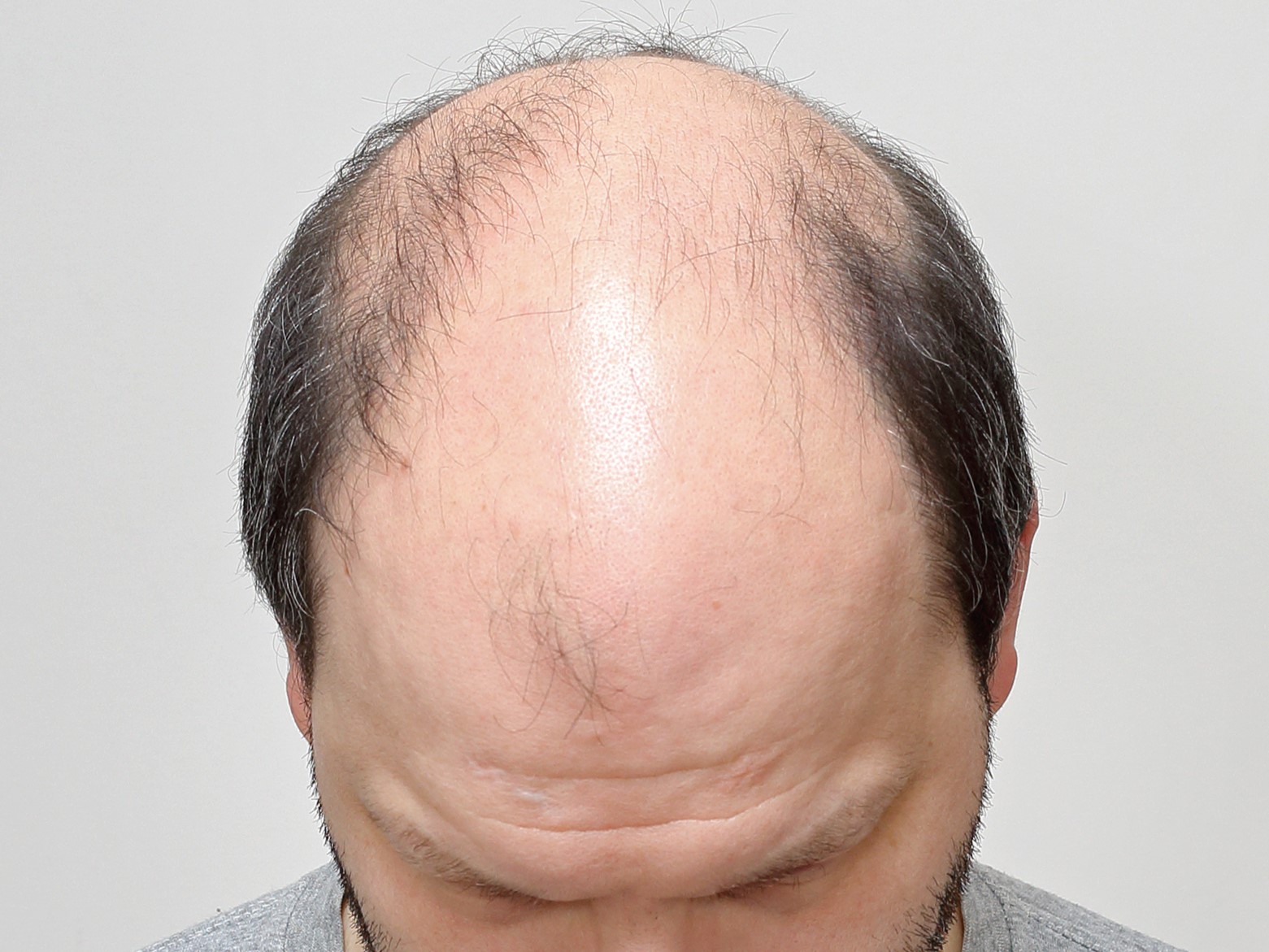 Мужская АГА