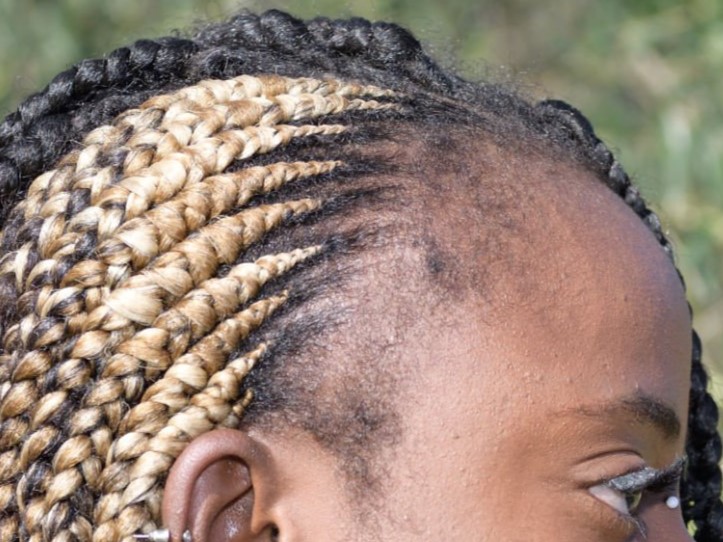 тракционная алопеция