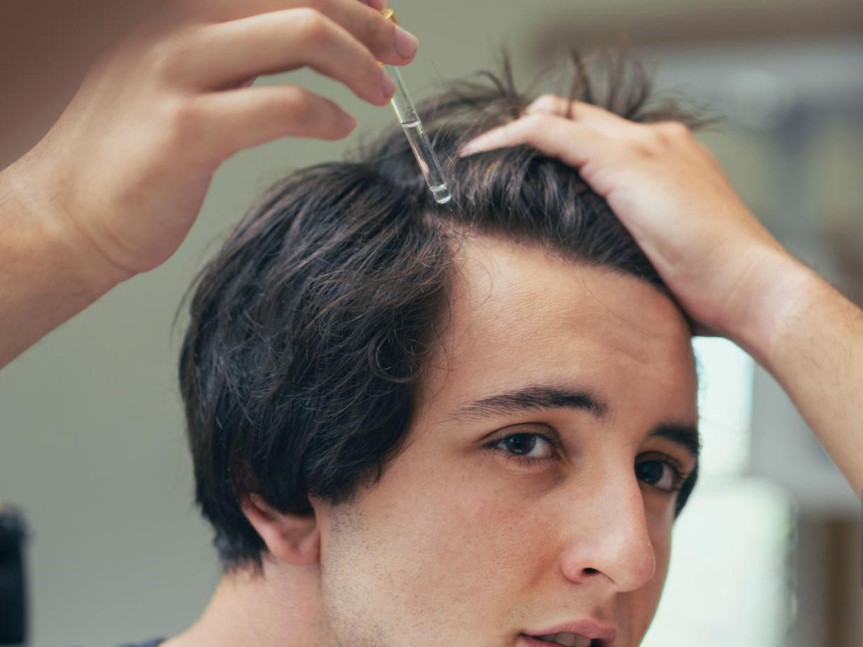 кофеин при выпадении волос, АГА