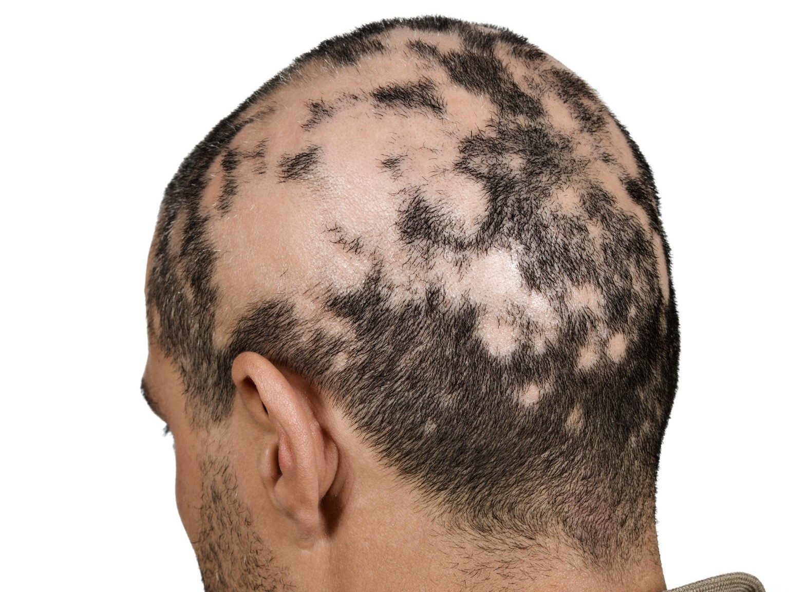 очаговая алопеция, гнездная алопеция, ареата, тотальное облысение