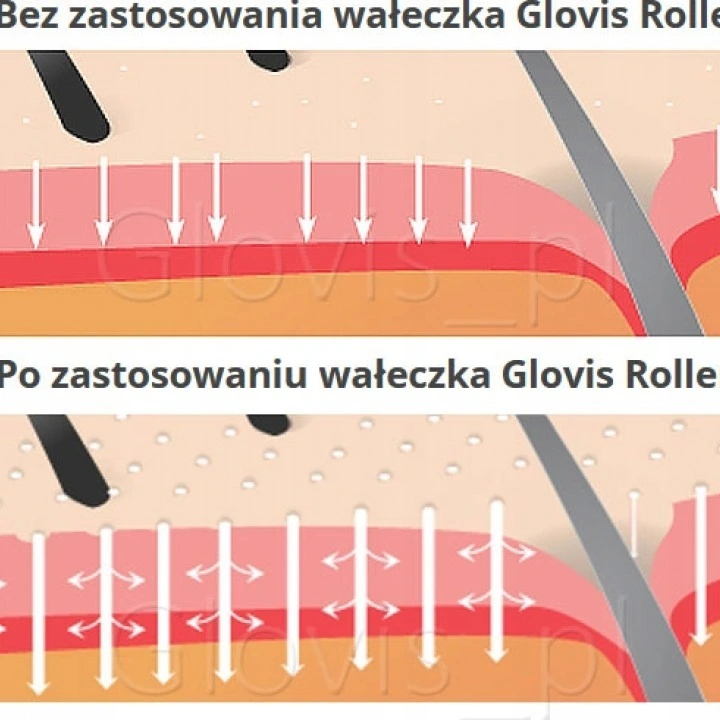Dermaroller przy wypadaniu włosów i AGA, Glovis