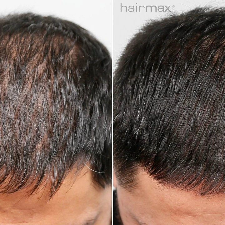 Oryginalna laserowa szczotka do wzrostu włosów Actonis 18 Dual Action LaserComb, HairMax
