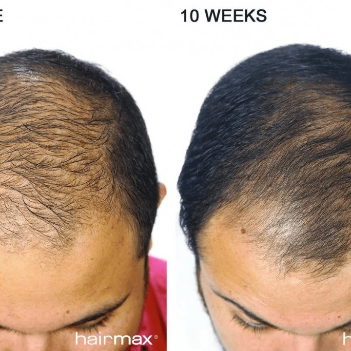 Лазерная оригинальная расческа для роста волос LaserComb Ultima 9, HairMax