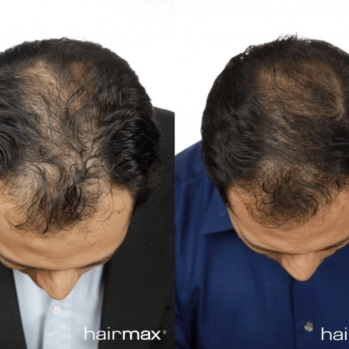 Oryginalna laserowa opaska przeciw wypadaniu włosów i AGA LaserBand 82, HairMax